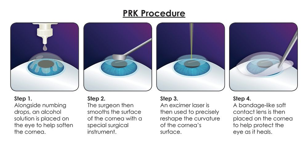Steps of a PRK